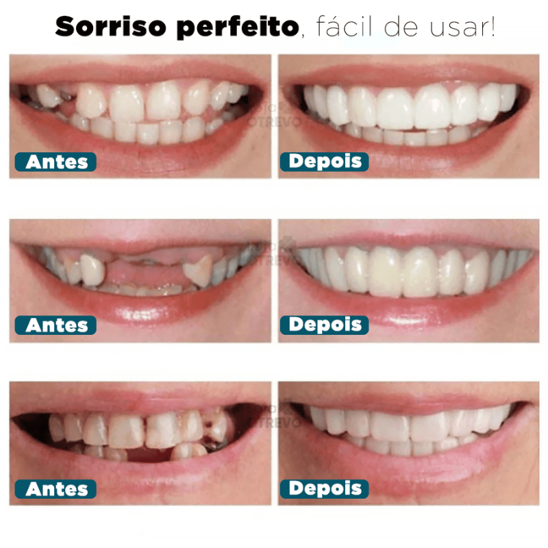 SmileFit® - Facetas Dentárias Naturais Removíveis